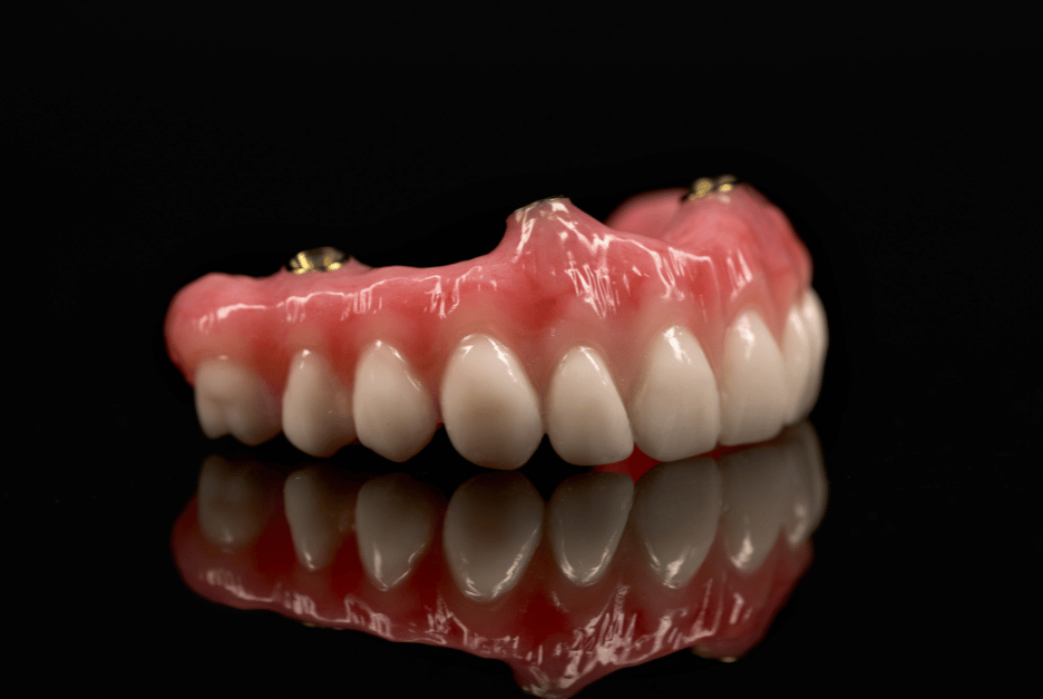 Screw Retained Acrylic Hybrid Denture PROCraft Dental Lab
